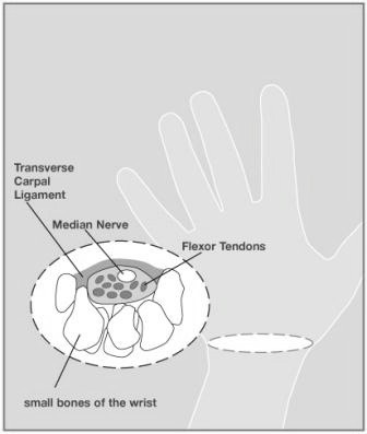 CarpalTunnel1 2