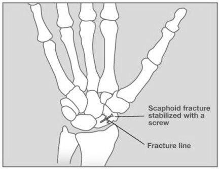 Scaph3_c