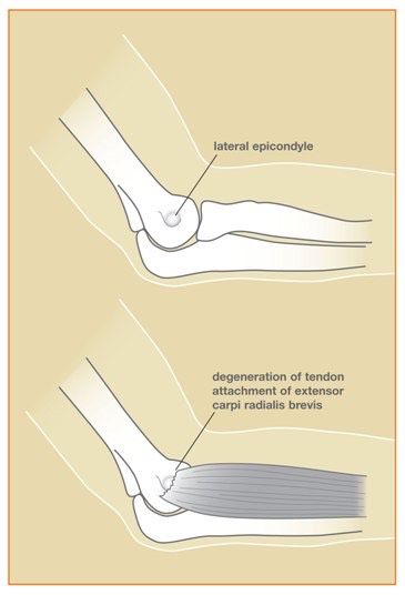Tenelbow_Image1