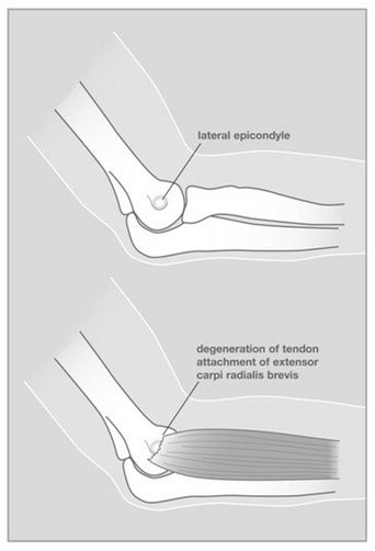Tenelbow_Image1