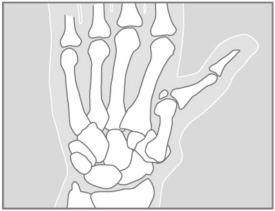 ThumbArth2_c