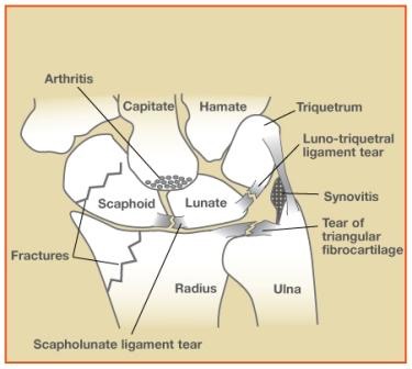 WristArthroscopy1