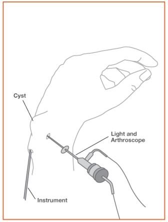 WristArthroscopy3