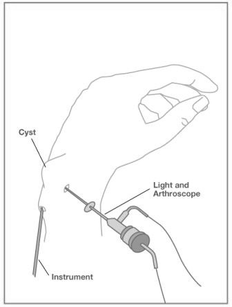 WristArthroscopy3