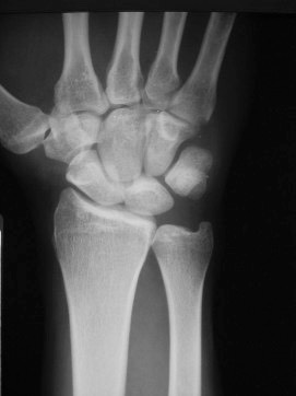 Wristsprains_image3