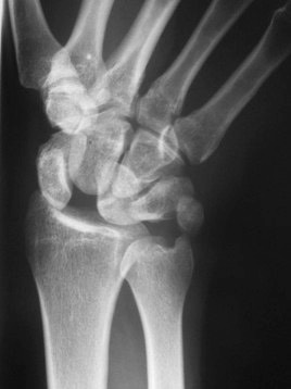 Wristsprains_image4